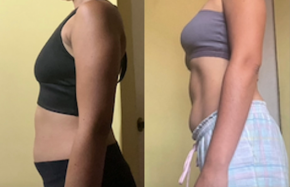 Comparativa de perfil del abdomen antes y después de practicar hipopresivos